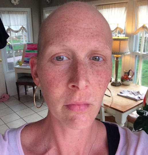 A photo of the author after going through chemotherapy