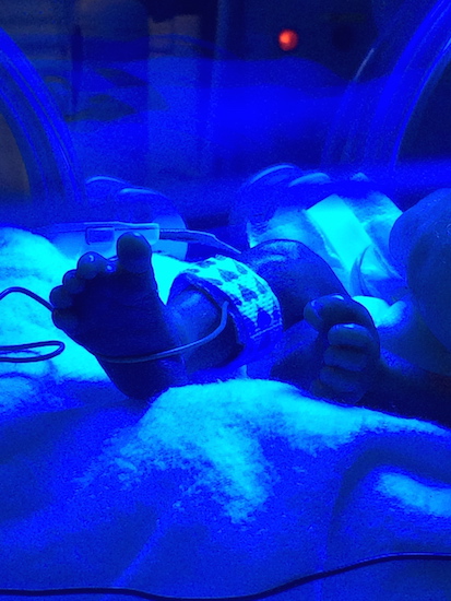 A baby's foot under the bili light