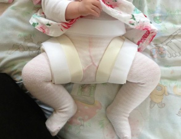 baby wearing a brace for hip dysplasia