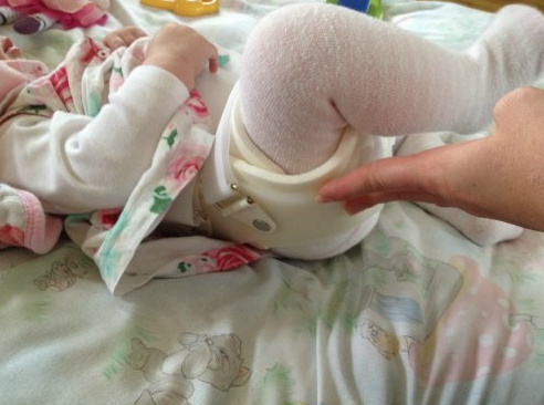 baby wearing a brace for hip dysplasia