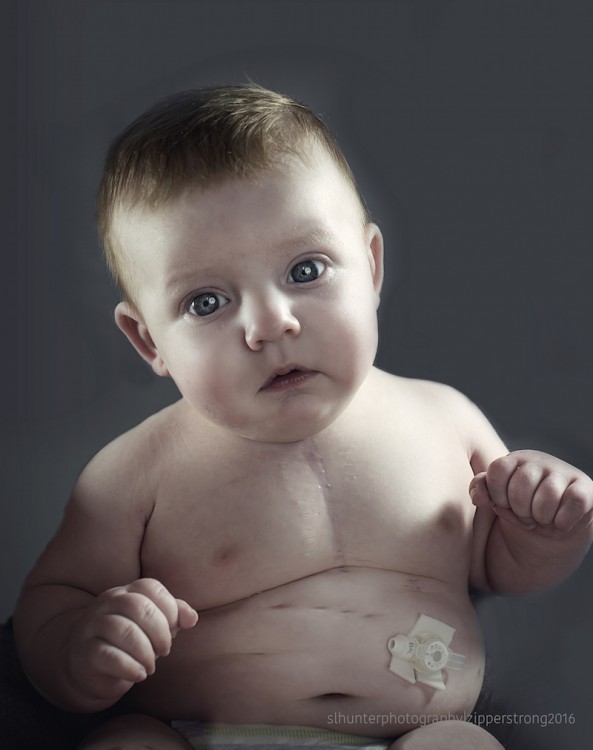Baby with congenital heart defect
