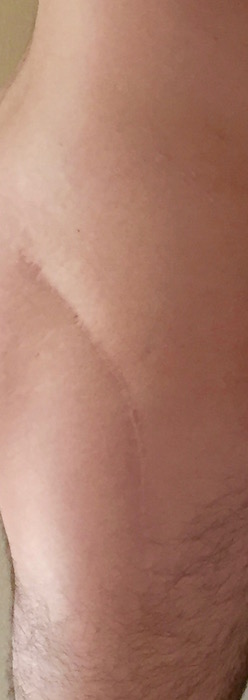 healed scar on hip