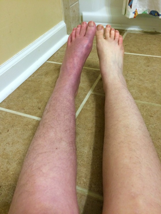 woman's legs showing one with complex regional pain syndrome
