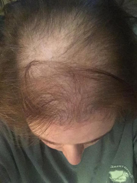 top of woman's head with thinning hair