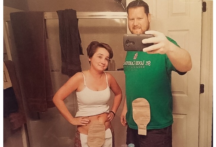 man and woman in front of mirror showing ostomy bags