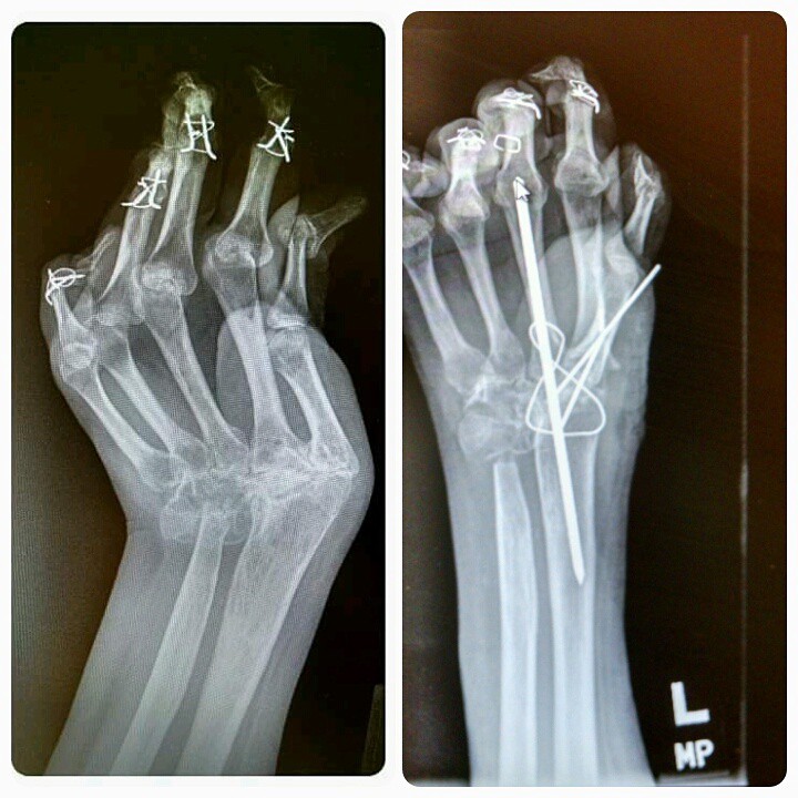x ray of broken fingers
