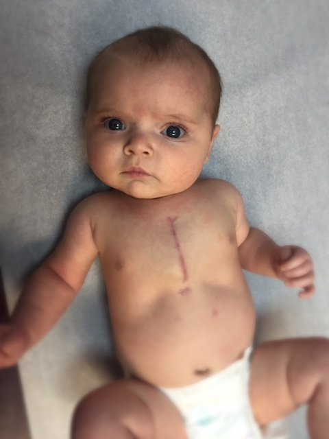 author's daughter with scar from heart surgery