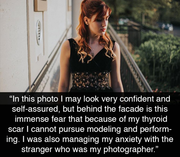 Red-headed model. "In this photo I may look very confident and self-assured, but behind the facade is this immense fear that because of my thyroid scar I cannot pursue modeling and performing as I will not be wanted. I'm trying to soak in every moment now and hope that there is a future for my passions. I was also managing my anxiety with the stranger who was my photographer."