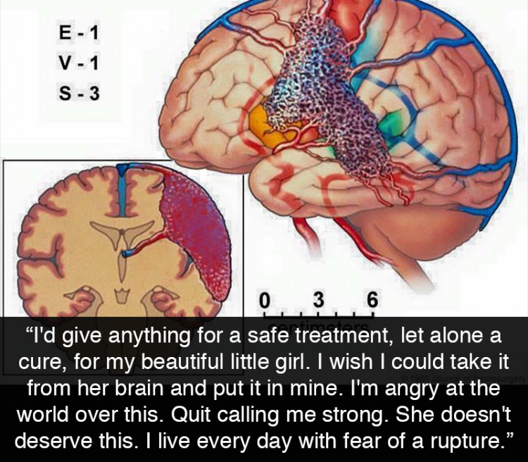 diagram of a brain. text reads: "I'd give anything for a safe treatment, let alone a cure, for my beautiful little girl. I wish I could take it from her brain and put it in mine. I'm angry at the world over this. Quit calling me strong. She doesn't deserve this. I live every day with fear of a rupture."