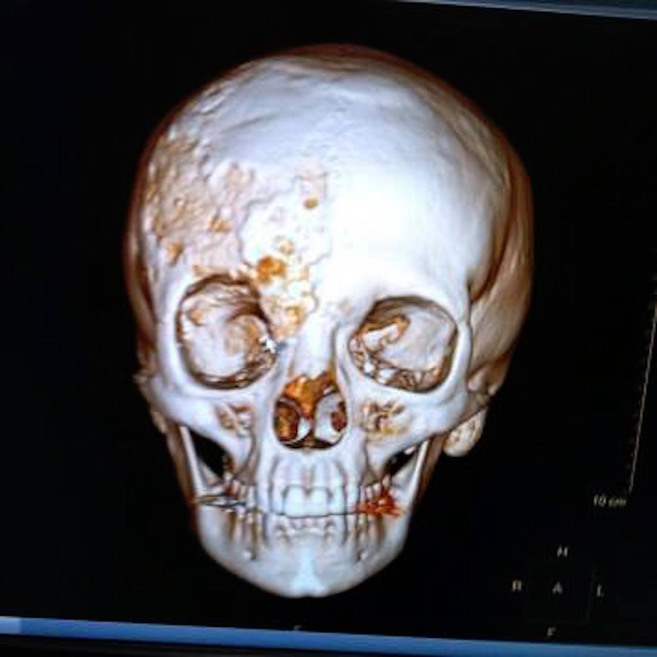 skull of a teen with fibrous dysplasia