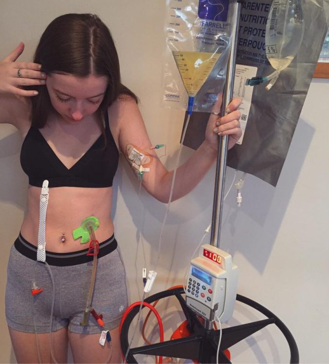 woman next to iv pole with tube in stomach