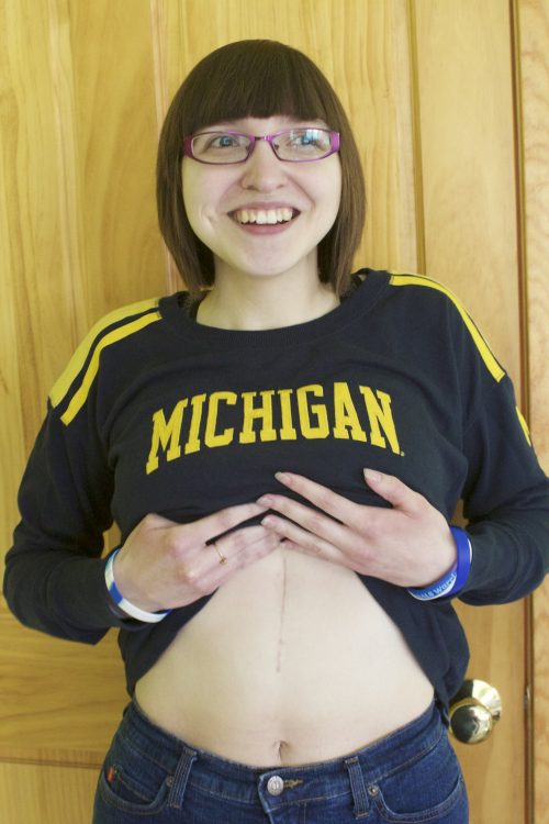 girl holding up shirt to show scar on stomach