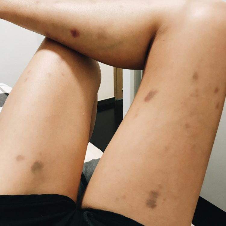 bruises on legs