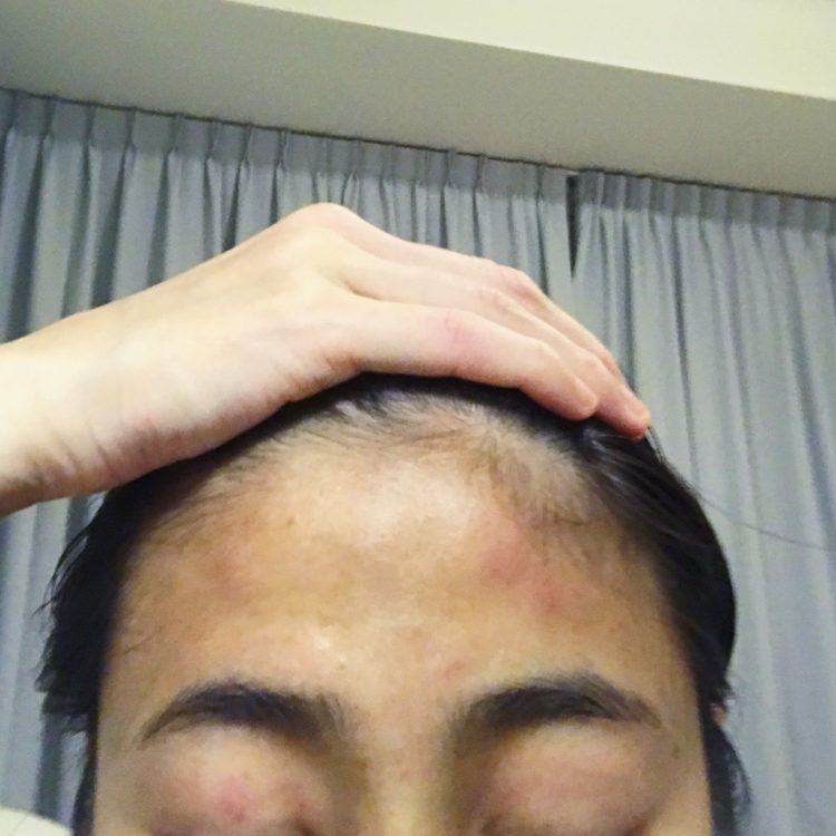 bruises on forehead