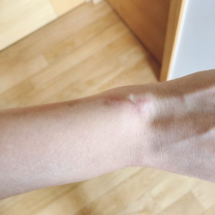 scar on wrist