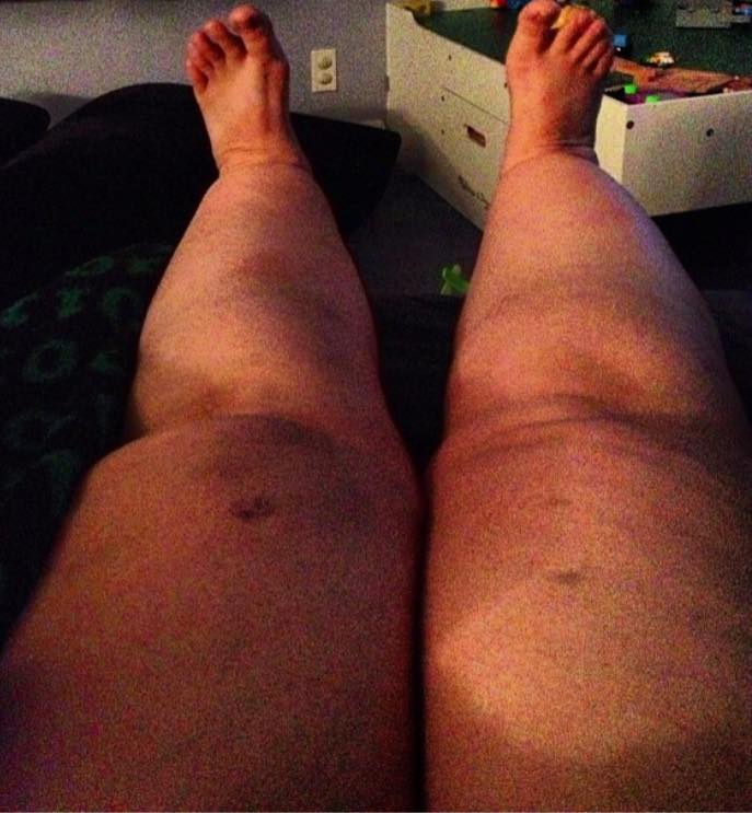woman's legs swollen due to lipedema