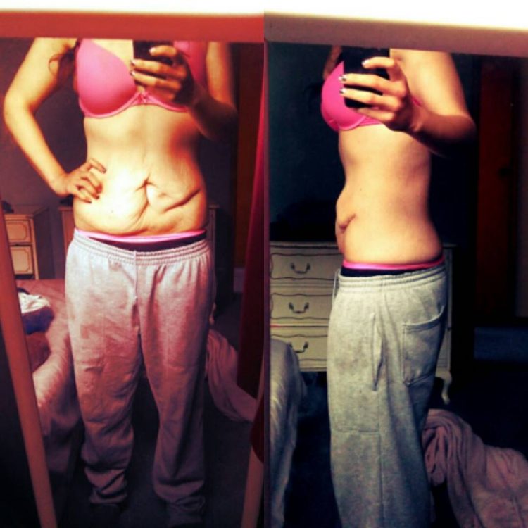woman with excess skin around her abdomen due to weight loss