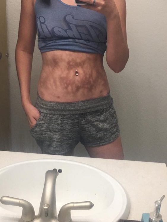 woman with burns on her stomach from heating pads