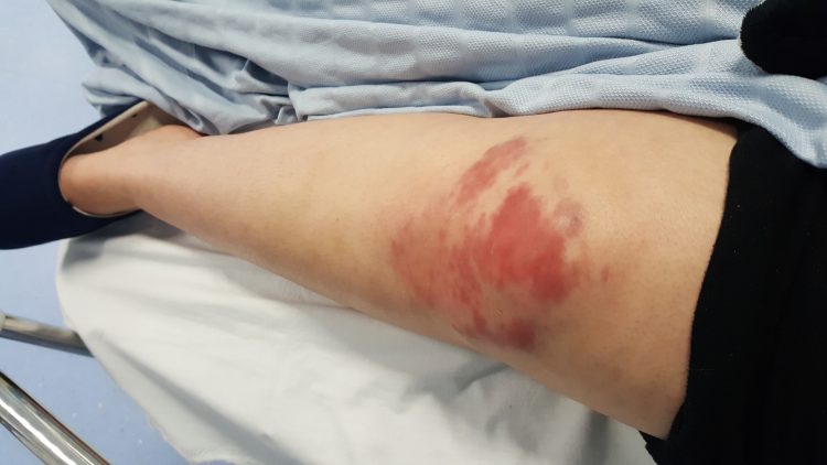 large bruises and wounds on a woman's knee from falling down the stairs after a seizure