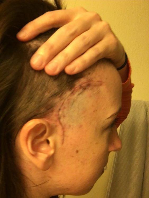 woman with scar on the side of her head after brain surgery