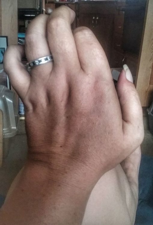 woman whose hands are bent from rheumatoid arthritis