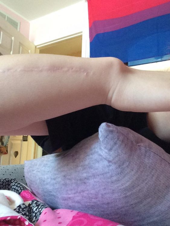 woman's wrist with broken bone and scar from dwarfism