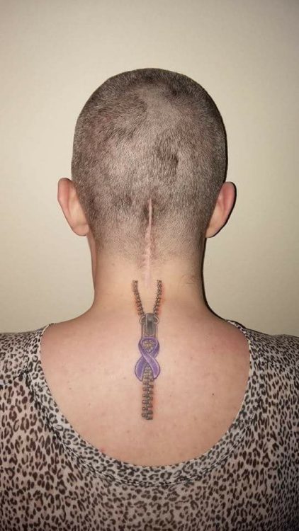woman with scar on the back of her head/neck from chiari