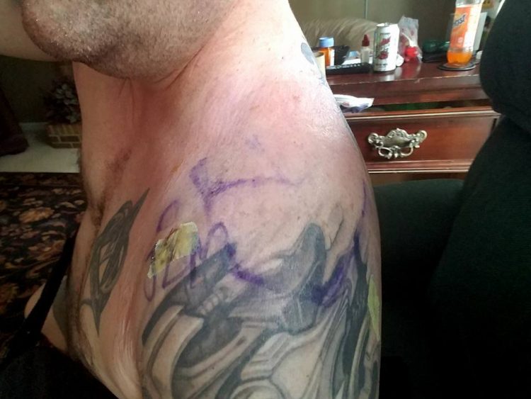 a scar on a man's shoulder surrounded by tattoos