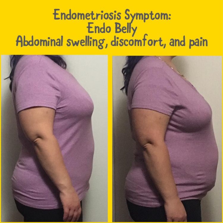 side by side photos of a woman's stomach with and without abdominal swelling