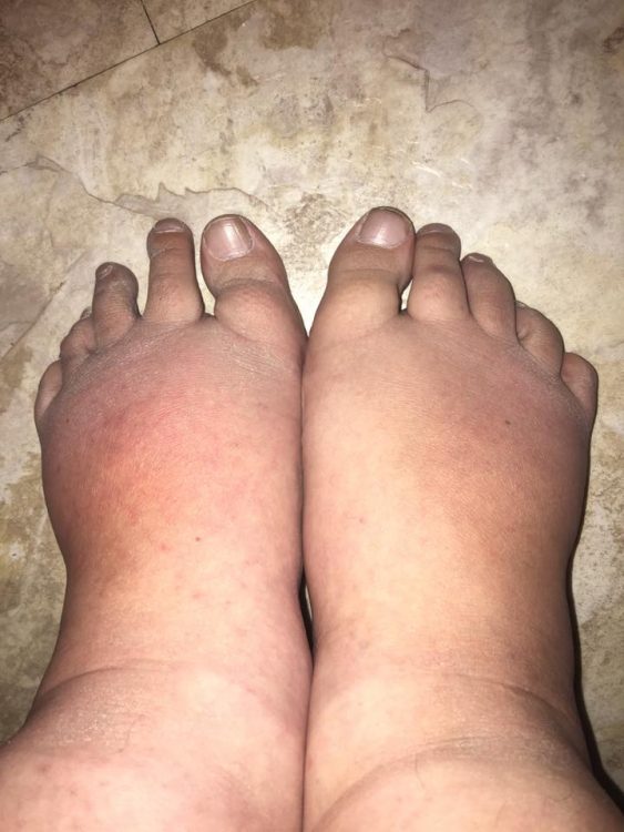 a woman's swollen feet