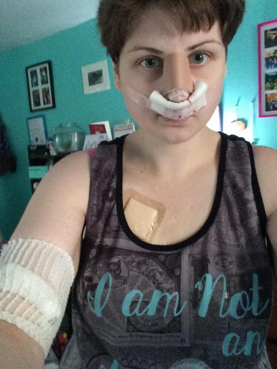 woman after surgery with multiple bandages on her nose, face, chest and arm