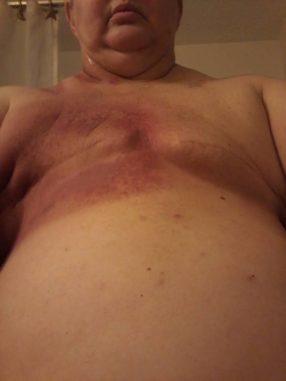woman's chest after a double mastectomy with burns from radiation treatment
