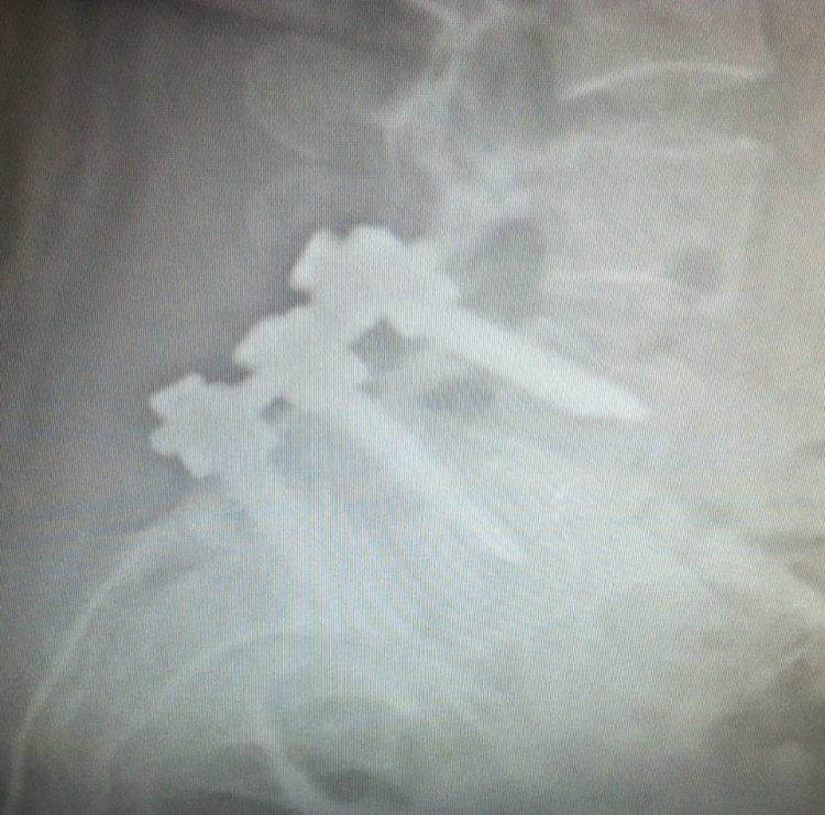 x-ray of screws in a woman's spine