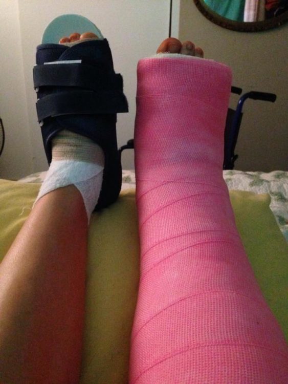 woman with a cast on one leg and a foot brace on the other