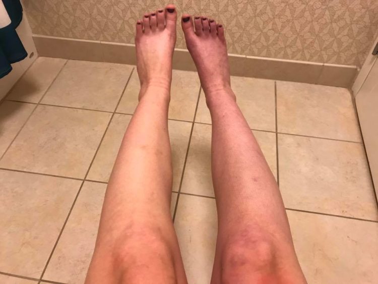 woman's legs with blood pooling