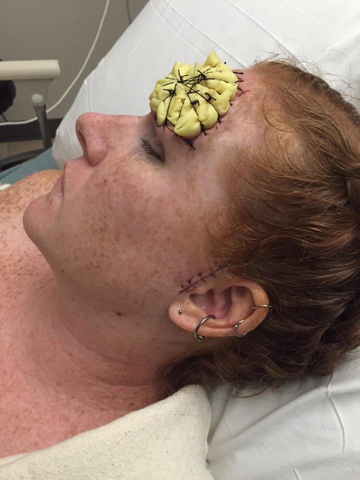 woman with melanoma cancer in hospital bed