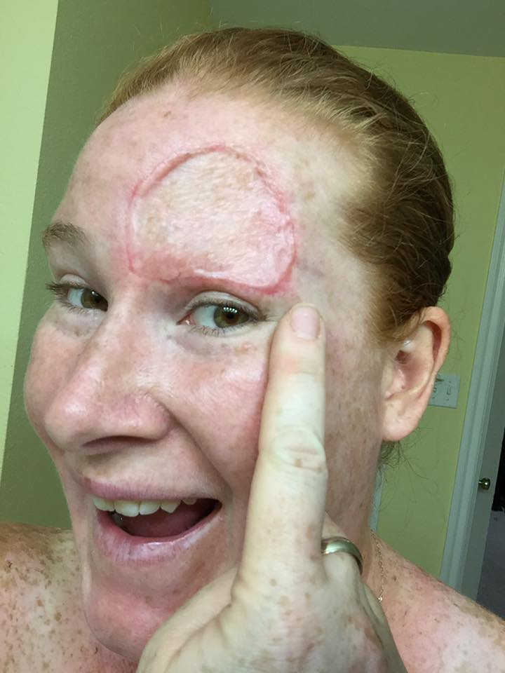 woman with melanoma cancer pointing to eyebrows