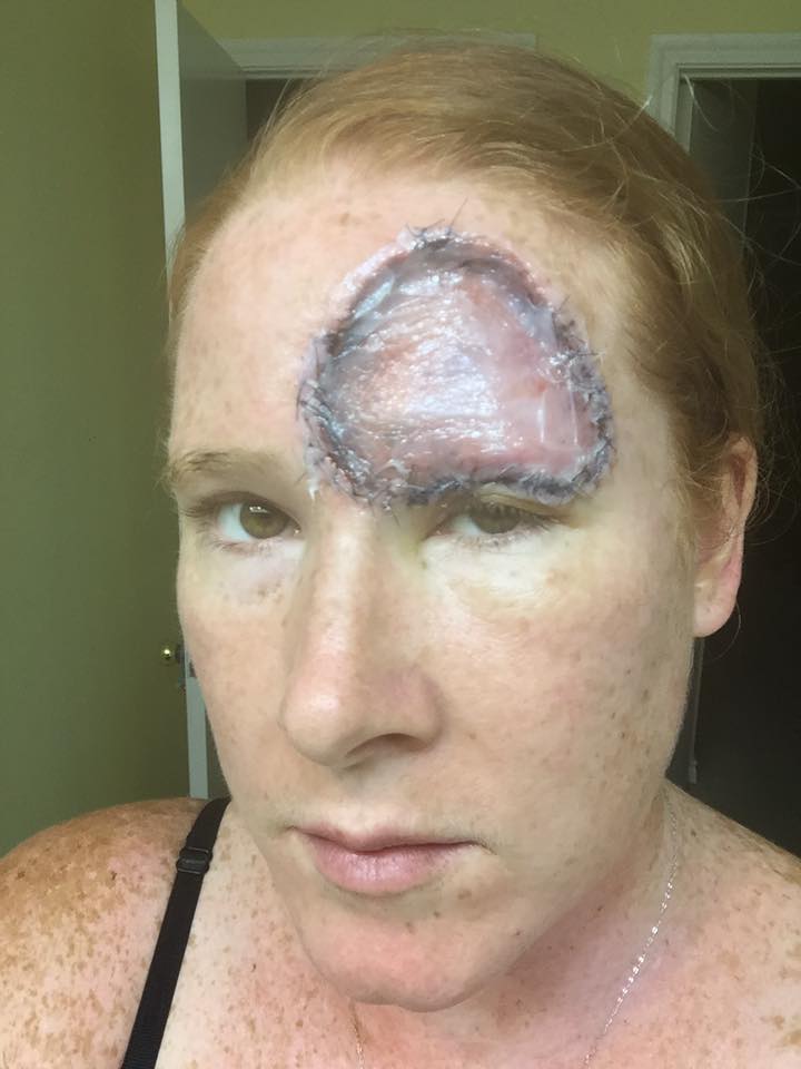 woman with melanoma cancer close up of head scar