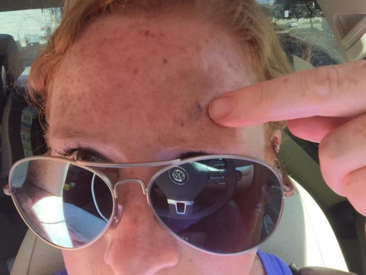 woman with melanoma cancer pointing to mole on forehead
