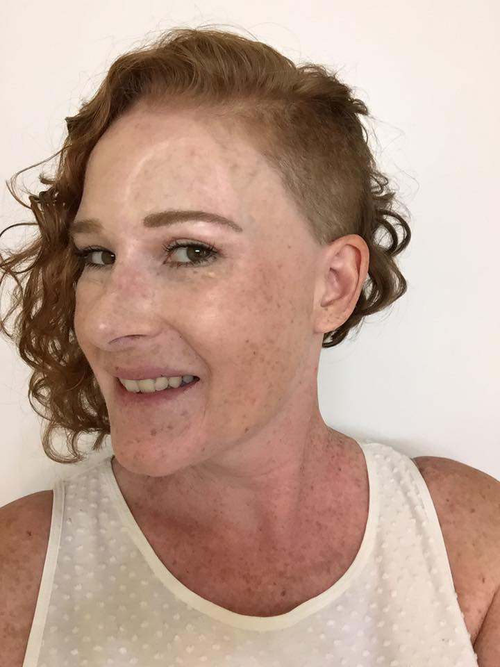 woman with melanoma cancer with cool haircut