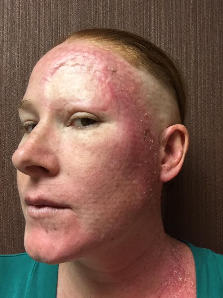 woman with melanoma cancer close up of radiation treatment