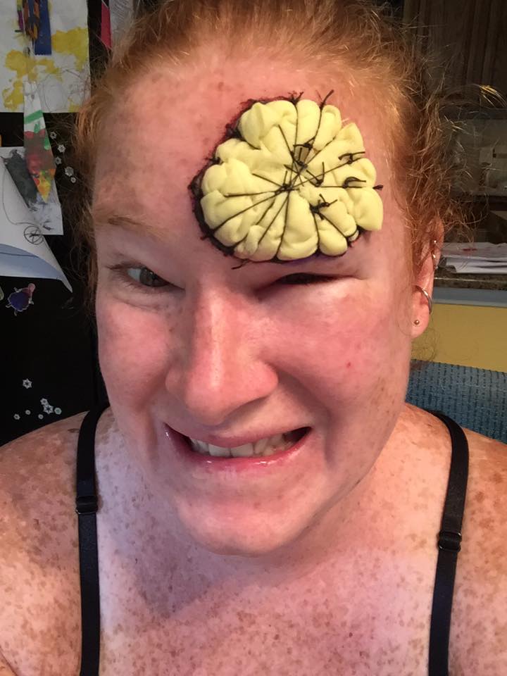 woman with melanoma cancer with compression sponge on head