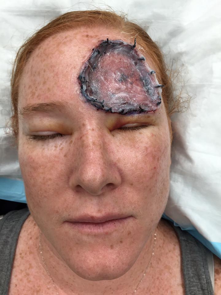 woman with melanoma recovering after surgery