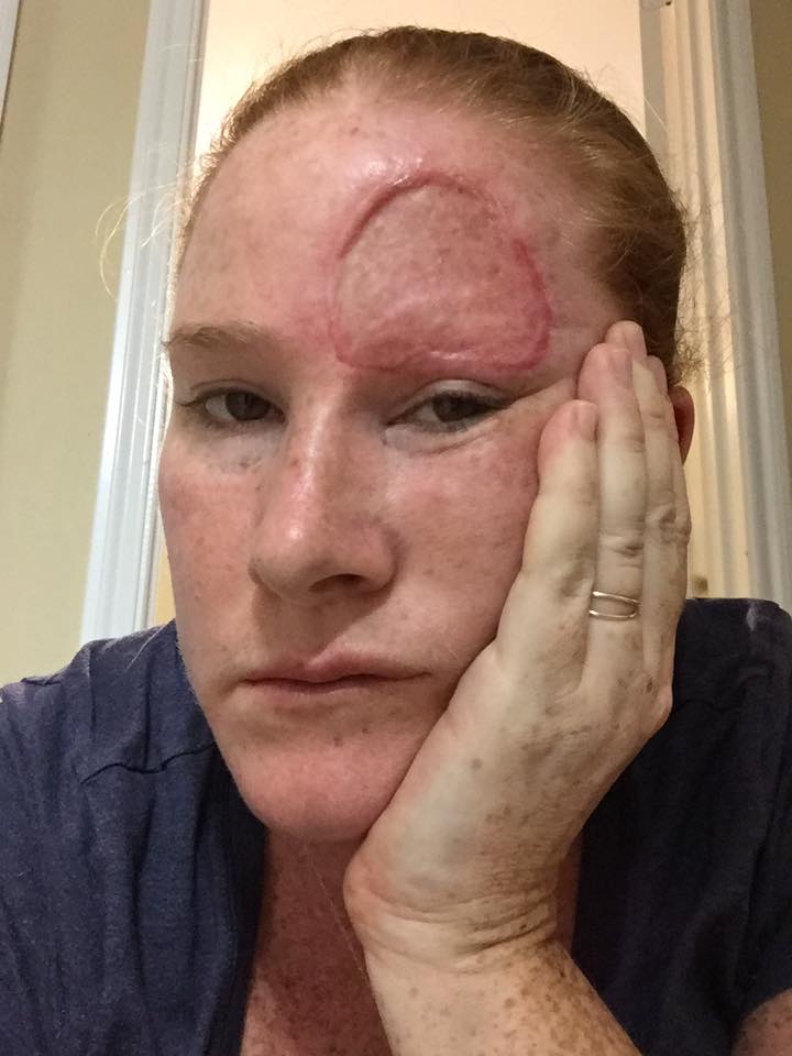 woman with melanoma cancer feeling tired