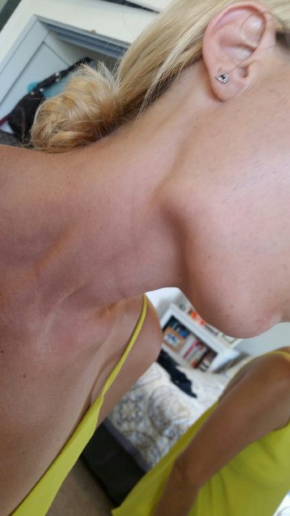 woman with enlarged lymph node in her neck