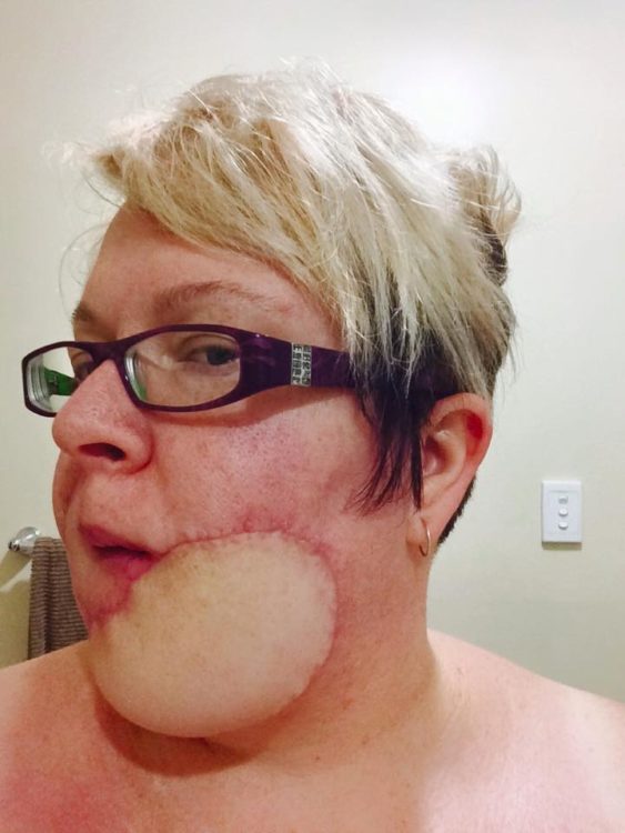 side view woman chin with skin cancer