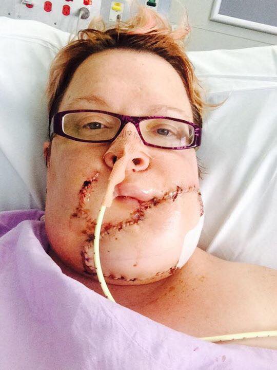 woman with skin cancer on chin lying in hospital bed