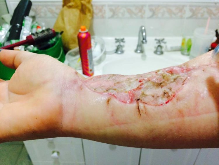 skin cancer arm removal closeup