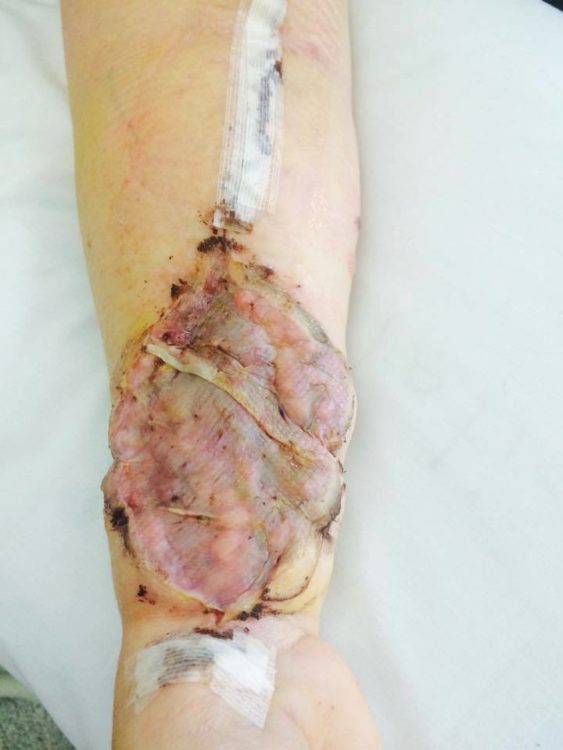 close up skin cancer arm removal