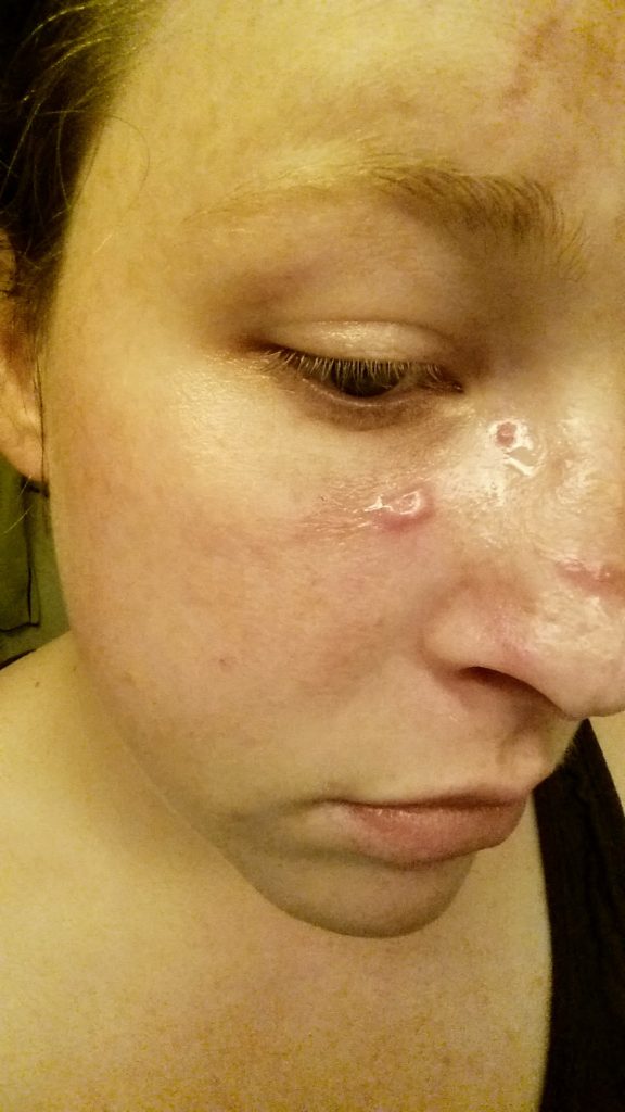 close up skin cancer woman